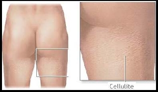 cellulite (pefs)