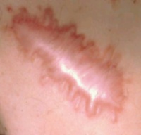 cicactrice cheloide