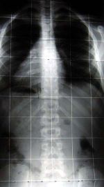 radiografia rx rachide frontale