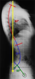 radiografia rx rachide sagittale